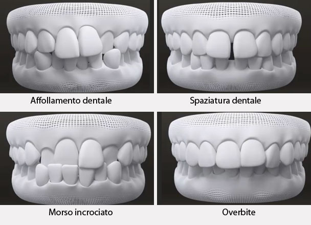morsi-dentali