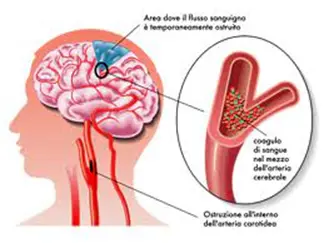 stenosi carotide
