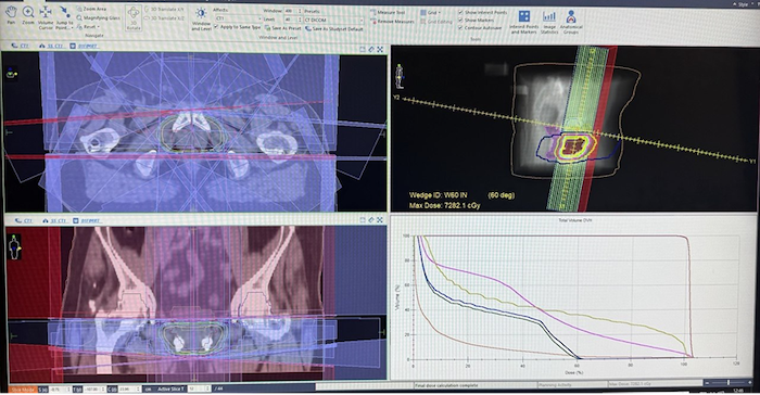 Tumore alla prostata e aumento del PSA dopo lintervento il ruolo della radioterapia