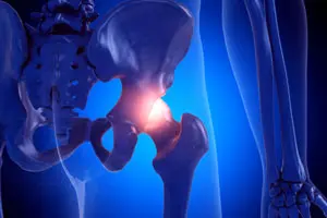 Artrosi dell'anca: prevenzione e rimedi.