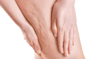 Cellulite e alimentazione: ecco i cibi da evitare.