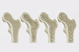 Come ci si accorge di soffrire di osteoporosi?