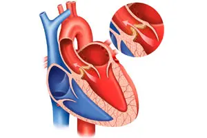 La stenosi della valvola aortica: domande e risposte.