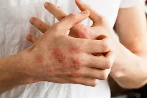 Lo stress in dermatologia