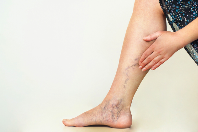 Vene varicose degli arti inferiori? Oggi si trattano in ambulatorio e con la “colla”.